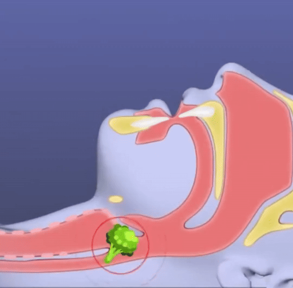 AirwayClear™ Anti-Choking Device - AirwayClear - Anti Choking Device
